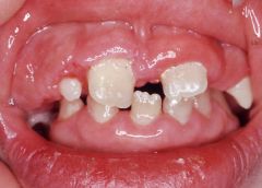 enamel hypoplasia: increased risk of caries, regular dental hygiene visits and good home care, easy to manage pt