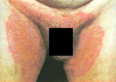 "jock itch"
caused by Microsporum rubrum (which also causes tinea pedis)presents with erythema, scaling, and maceration in the inguinal creases