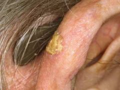 

A 60-year-old man asks you to have a look at a 'sore' on his right ear.



It has been present for around 6 months and is not painful. What is the most likely diagnosis?

 