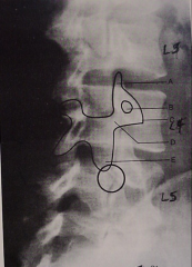 Cleft in pars articularis of vertebrae (scotty dog neck)