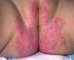 can be caused by atopic dermatitis, primary irritant dermatitis, or primary or secondary Candida albicans infection
80% of diaper rashes lasting longer than 4 days are colonized with candida
appears as fiery red papular lesions with peripheral pap...