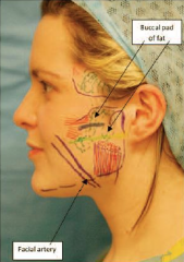 An accumulation of encapsulated fat superficial to the buccinator muscle.


 


The parotid duct lies superficial to the buccal fat pad and goes deep at its anterior border.


 


Loss of this fat pad gives the appearance of sunken cheeks.
