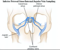 Into 2 petrosal sinuses (o top of petrosal bone)
the inferior meets the internal jugular at the sigmoid sinus