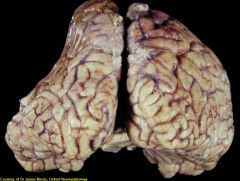 What intracranial haemorrhage can cause this morphology?
