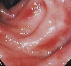 - Mild ulcerative colitis with loss of vascular pattern
- Hard to see the blood vessels
- Some whitening = accumulation of immune cells