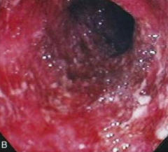 What does this endoscopy show?