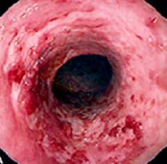 Ulcerative Colitis
- Erythematous
- Friable
- Loss of vascular pattern
- Also notice continuous and circumferential pattern