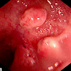 Ulcerative Colitis
- Inflammatory pseudopolyp - outpouching of inflammatory cells predominantly seen in UC
- Large population of goblet cells covers the pseudopolyps with mucous