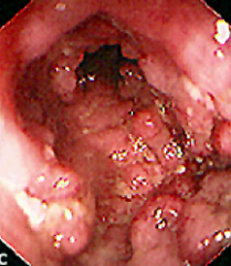 What does this endoscopy show?