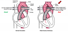 There is a duct between arteries (aorta and pulmonary arteries) in utero because ond't need to go through the lungs

This is suppose to close off once born and become a ligmaent (ligamentum arteriosus) however if it doesn't have mxiing of blood f...