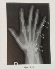 In the PA projection of hand seen in fig 2-19 which # identifies proximal interphalangeal joint
A. 4
B. 5
C. 6
D. 7