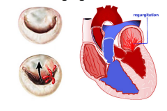 With regurgitation does not close all the way so when ventricles contracts some blood goes back into the atria therefore lowering the efficiency of the heart
