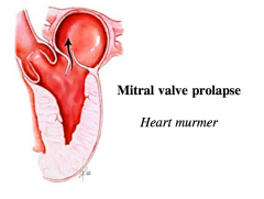 Little extra flap of tissue can prolapse into atrium and cause a flutter (sound of heart murmur)