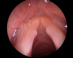 Usually symmetric swelling or masses of the middle portion of the membranous vocal fold