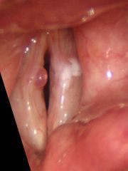 Out-pouching of mucosa, distended by edema and loose stroma