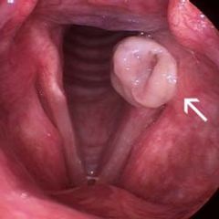 Vocal abuse
Throat clearing
Intubation
GERD
