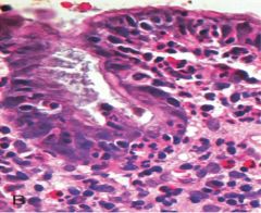 intraepithelial & lamina propria neutrophils


 


*plasma cells, lymphocytes, & macrophages may also be present