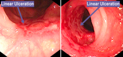 Crohn's Disease with linear ulcerations