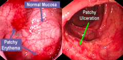 Crohn's Disease: skip lesions (areas of inflammation are adjacent to normal mucosa)