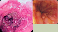 Crohn's Disease: Cobble-stone appearance