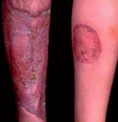 Pyoderma Gangrenosum: violet tinge at endges of rash, extra-intestinal manifestation of IBD (more common in UC) (1-2%)