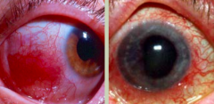 Ocular complications (5-15%), extra-intestinal manifestation of IBD:
- Left: Episcleritis - white part of eye is very inflamed, usually not painful, more of a cosmetic issue
- Right: Uveitis - painful inflammation of the iris that hurts between ...