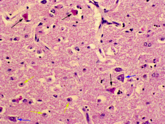 This is a picture of infarcted brain tissue. What type of cell does the arrow point to?