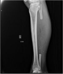 A 47-year-old man presents with 1 week of left leg pain. 6 months prior he underwent a vascularized free-fibula bone graft from his left leg to his right hip for avascular necrosis. The pain is located at the level of his donor site and is worse w...