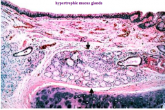 Increased mucus glands (hypertrophy)