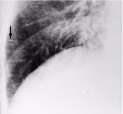 What radiographic hallmark is seen in this image and the one above?