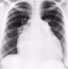What sided heart failure is this? What appearance does this image have?