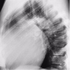 What sided heart failure is this? What appearance does this image have?