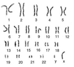 a chart displaying chromosome pairs in an individual organism; can show unsual number of autosomes or sex chromosomes which can spot genetic problems 