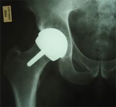 Which of the following is the most common cause of early revision surgery (<20 weeks) following a hip resurfacing arthroplasty?  
1.  Periprosthetic fracture
2.  Rupture of abductors
3.  Dislocation
4.  Heterotopic ossification
5.  Post-opera...
