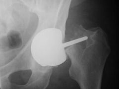 Periprosthetic fracture, specifically femoral neck fracture, is the most common cause of early revision less than 20 weeks following surgery. Anss