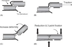1) Exaggerate the deformity
2) Reverse mechanism of injury
3) Reduce
4) Three-point fixation (2 on the side distal to injury)
