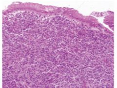 MALT lymphoma


(lymphoma infiltrates mucosa & obliterates gastric glands)


 


NF-kB activation---> MALT lymphoma