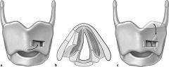 Vocal fold is medialized by permanent implant placed in paraglottic space, via a window in thyroid cartilage
- usually performed under local anesthesia, so that results can be monitored during the procedure

NOT effective in pts with flaccid pa...