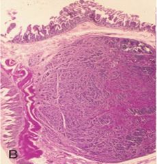 Gastric carcinoid tumors may arise in the mucosa or submucosa (img).  How do they appear histologically?