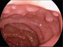 Hamartomatous polyps in the in the colon, esophagus, stomach and coaselscing mucosal lesions in the buccal mucosa with "cobblestone" of the tongue