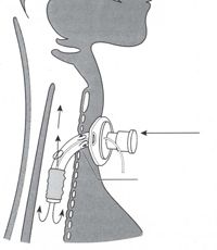 A: Deflate tracheostomy cuff, insert one way valve, insert fenestrated piece




