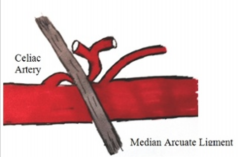 Median arcuate ligament syndrome