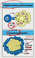 macrophage is activated just fine, but it still can't kill the material (could be unkillable or a substance like coal dust that just can't be digested). It makes an immune granuloma.