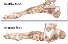 impaired pain sensation

Explanation: Charcot joints, most often seen in the foot but can occur elsewhere, are the consequence of loss of protective sensation of pain. The neuropathy is seen often in diabetes, and may be due to microvascular disea...