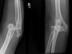 what is the #1 most common major joint dislocation
What a 2nd most common major joint dislocation in the
Was most common direction for an elbow dislocation