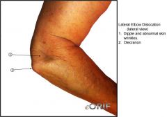 shoulder dislocation
Elbow dislocation
Posterior lateral dislocation