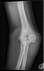 what is injured with a terrible triad elbow injury