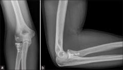 disruption of the LCL
Radial head fracture
Coronoid tip fracture
Dislocation of the elbow