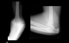 patient presents emergency room at this x-ray no signs of compartment syndrome what is the diagnosis AKA
What is injured with this type of injury
What is the treatment-for simple injury vs complex injury