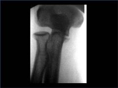 A 34-year-old male falls from a roof and sustains a right elbow dislocation that is closed reduced in the emergency room. An AP radiograph is shown in Figure A. This injury pattern is at highest risk for which of the following?


 


1.  An...